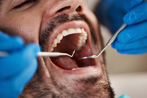 Best Emergency Dentist for Lost Fillings or Crowns in Phoenixville, PA